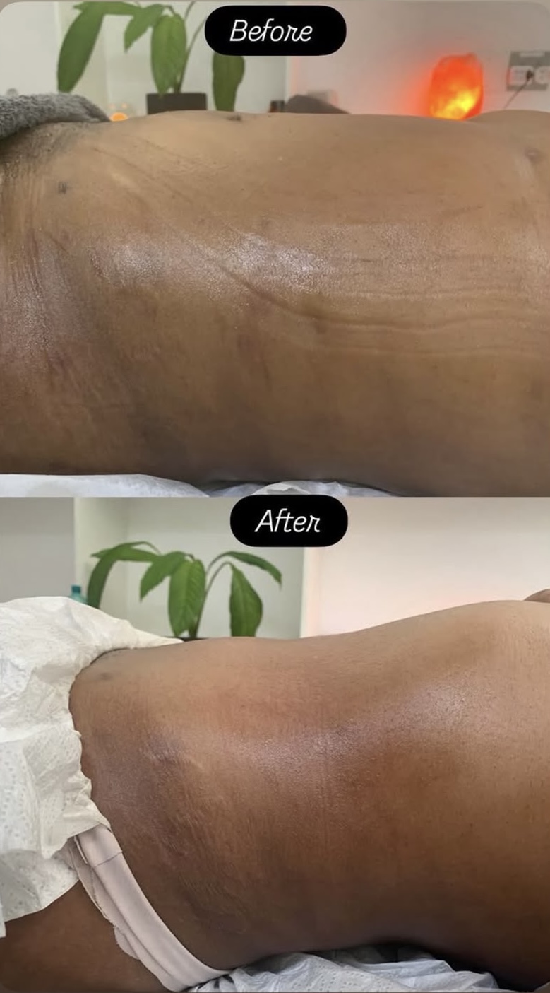 Before and after Wood therapy · abdomen at Bodywood by Thando