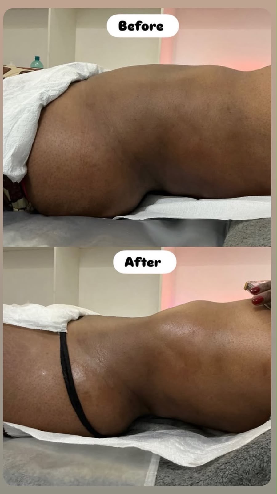 Before and after Wood therapy · lower back at Bodywood by Thando